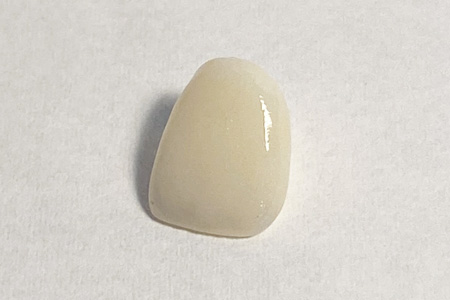 ジルコニアボンドクラウン